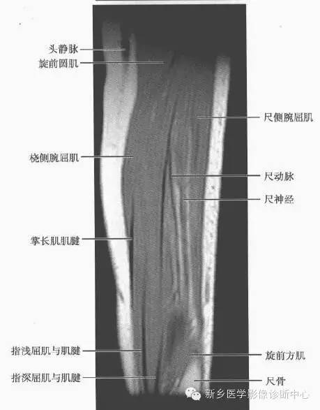 影像PPT - 前臂精细MR断层解剖标注-37