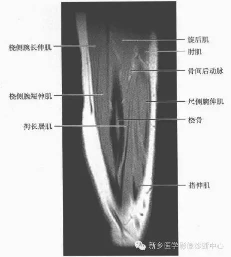影像PPT - 前臂精细MR断层解剖标注-46