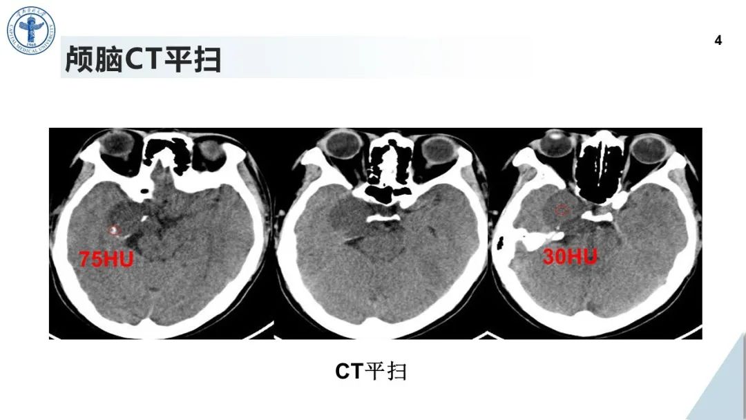 影像PPT - 【病例】鞍旁海绵窦高分化软骨肉瘤1例CT及MR影像-3
