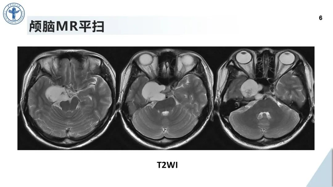 影像PPT - 【病例】鞍旁海绵窦高分化软骨肉瘤1例CT及MR影像-5