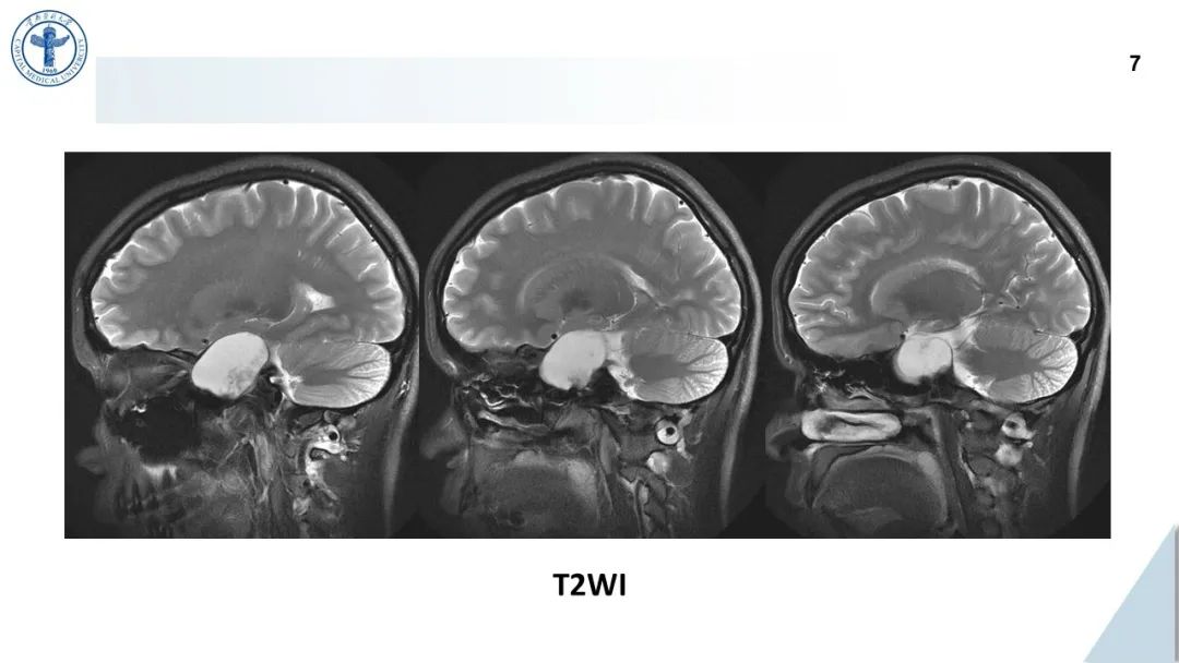影像PPT - 【病例】鞍旁海绵窦高分化软骨肉瘤1例CT及MR影像-6