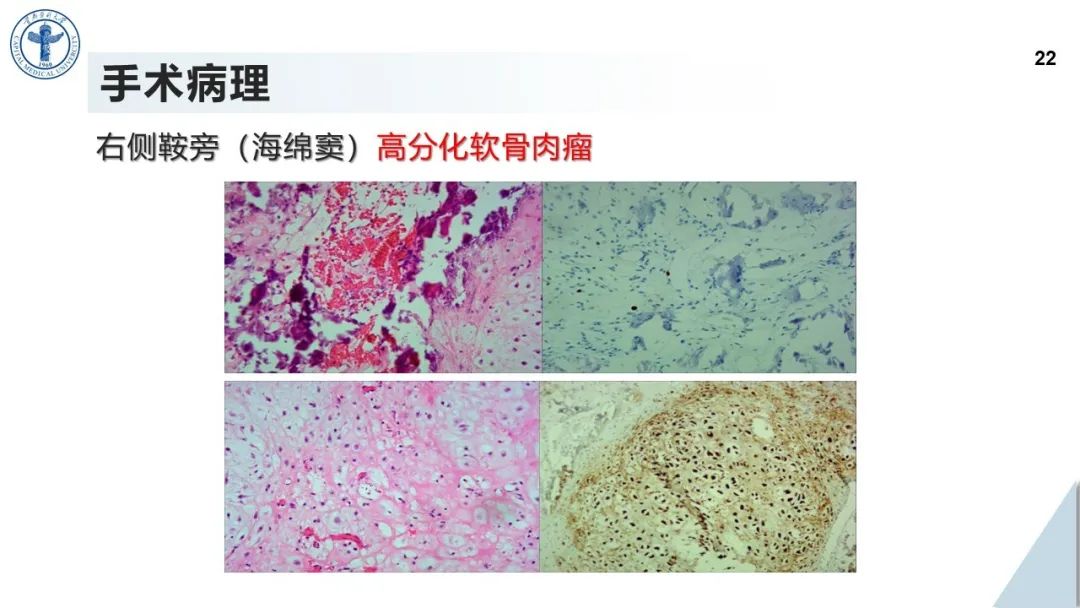影像PPT - 【病例】鞍旁海绵窦高分化软骨肉瘤1例CT及MR影像-21