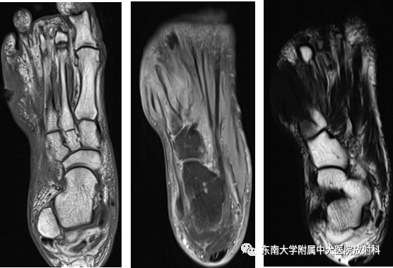 影像PPT - 【病例】糖尿病足2例MR影像-2 影像PPT - 【病例】糖尿病足2例MR影像-2