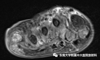 影像PPT - 【病例】糖尿病足2例MR影像-3 影像PPT - 【病例】糖尿病足2例MR影像-3