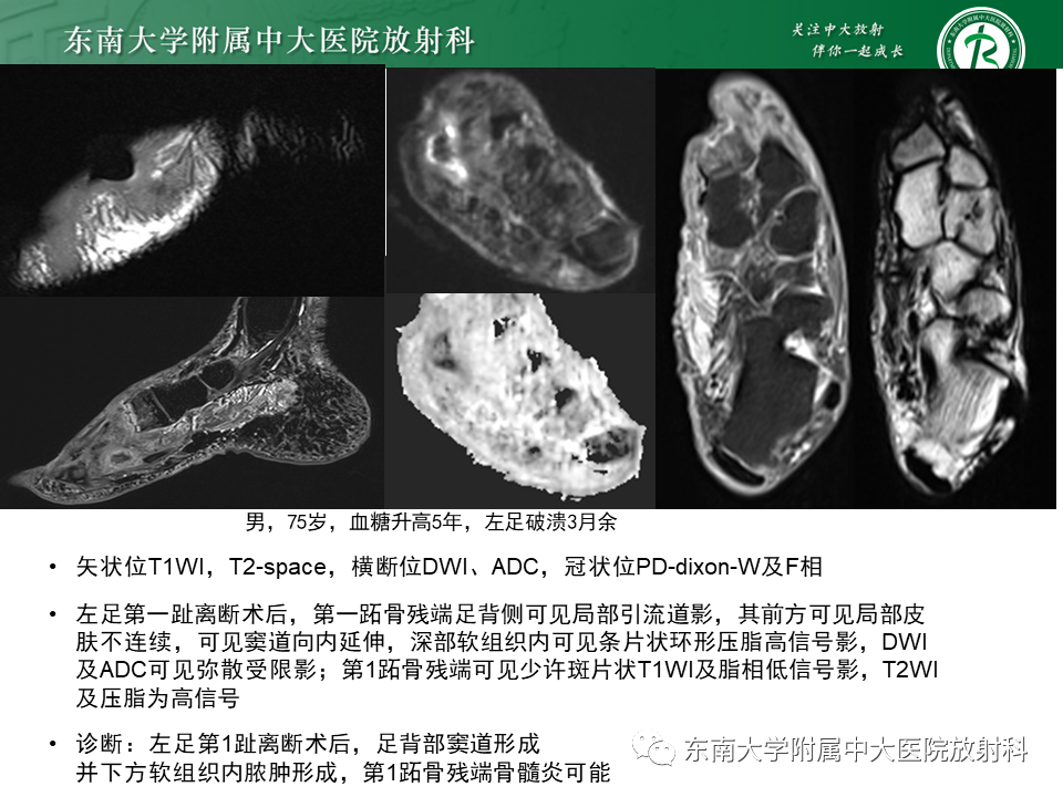 影像PPT - 【病例】糖尿病足2例MR影像-14 影像PPT - 【病例】糖尿病足2例MR影像-14