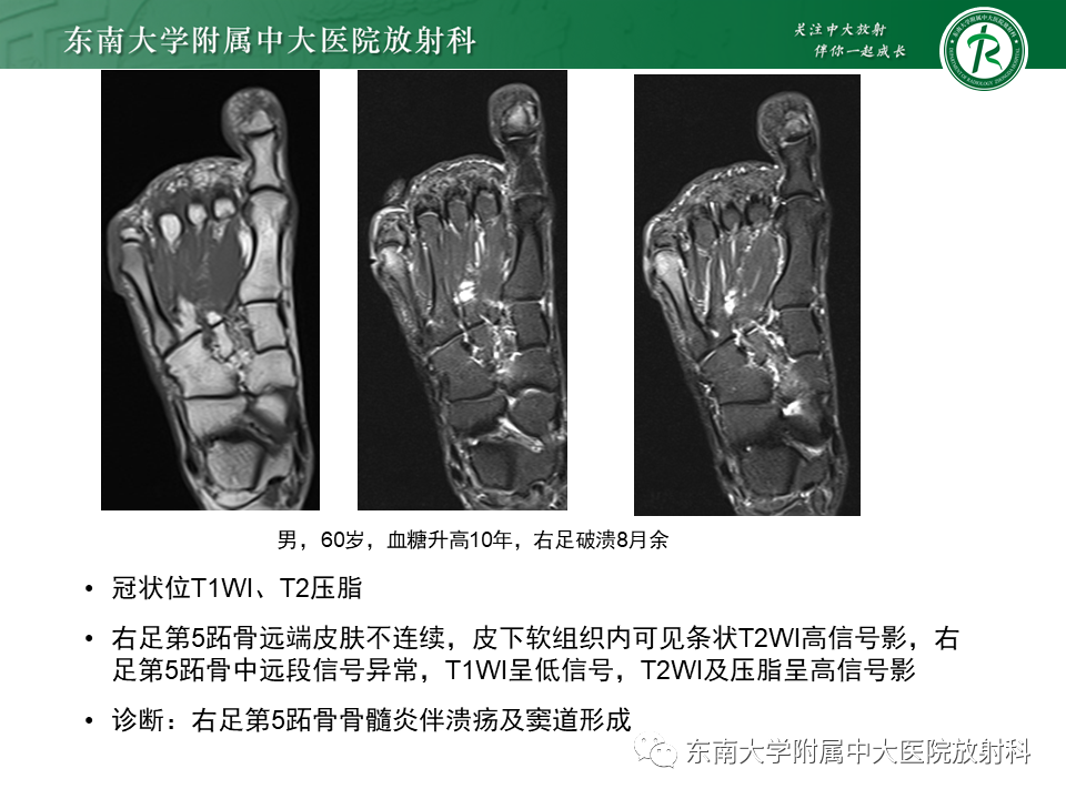 影像PPT - 【病例】糖尿病足2例MR影像-17 影像PPT - 【病例】糖尿病足2例MR影像-17