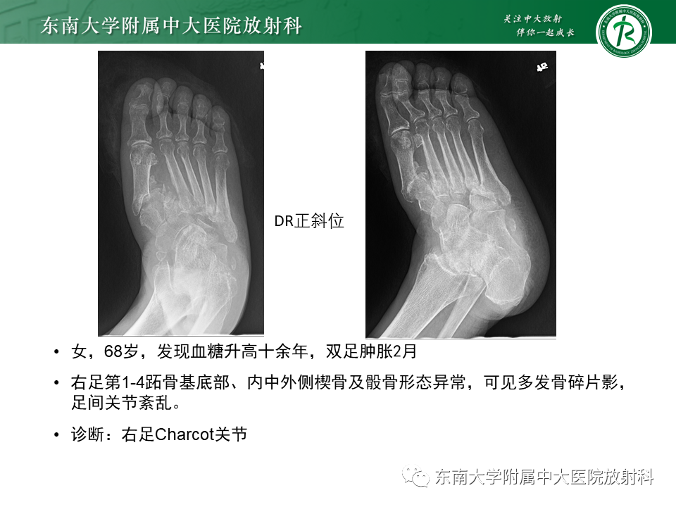 影像PPT - 【病例】糖尿病足2例MR影像-20 影像PPT - 【病例】糖尿病足2例MR影像-20