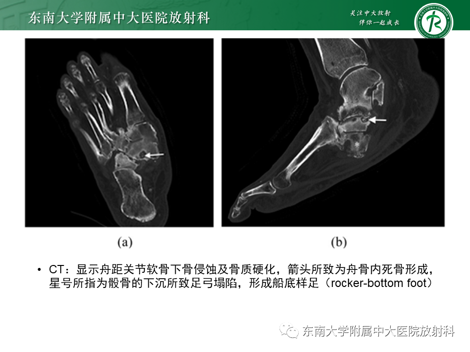 影像PPT - 【病例】糖尿病足2例MR影像-21 影像PPT - 【病例】糖尿病足2例MR影像-21