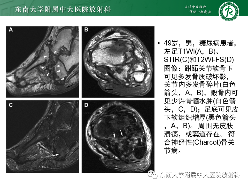 影像PPT - 【病例】糖尿病足2例MR影像-22 影像PPT - 【病例】糖尿病足2例MR影像-22