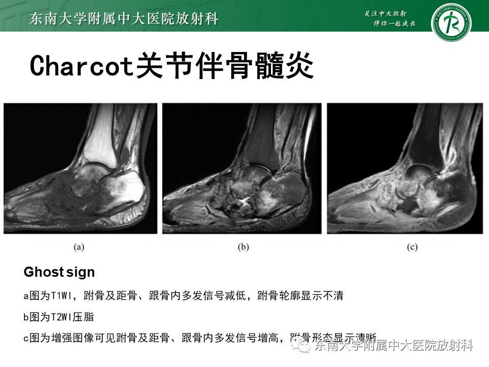 影像PPT - 【病例】糖尿病足2例MR影像-25 影像PPT - 【病例】糖尿病足2例MR影像-25