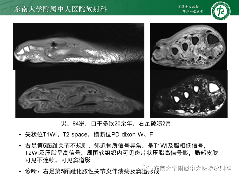 影像PPT - 【病例】糖尿病足2例MR影像-27 影像PPT - 【病例】糖尿病足2例MR影像-27