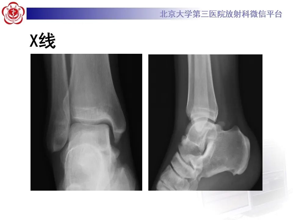 影像PPT - 【病例】踝关节后方撞击综合征1例X线CT及MR影像-3