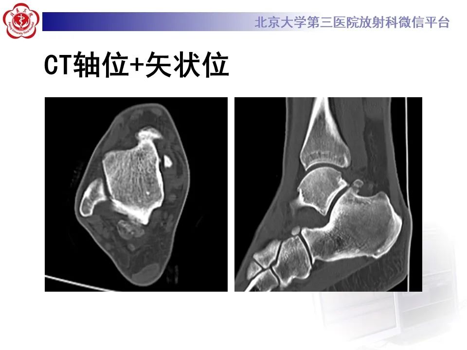 影像PPT - 【病例】踝关节后方撞击综合征1例X线CT及MR影像-4