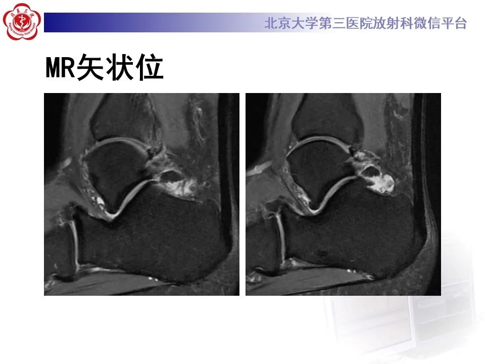 影像PPT - 【病例】踝关节后方撞击综合征1例X线CT及MR影像-5