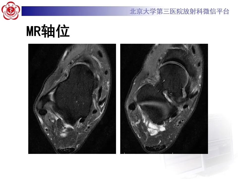 影像PPT - 【病例】踝关节后方撞击综合征1例X线CT及MR影像-6