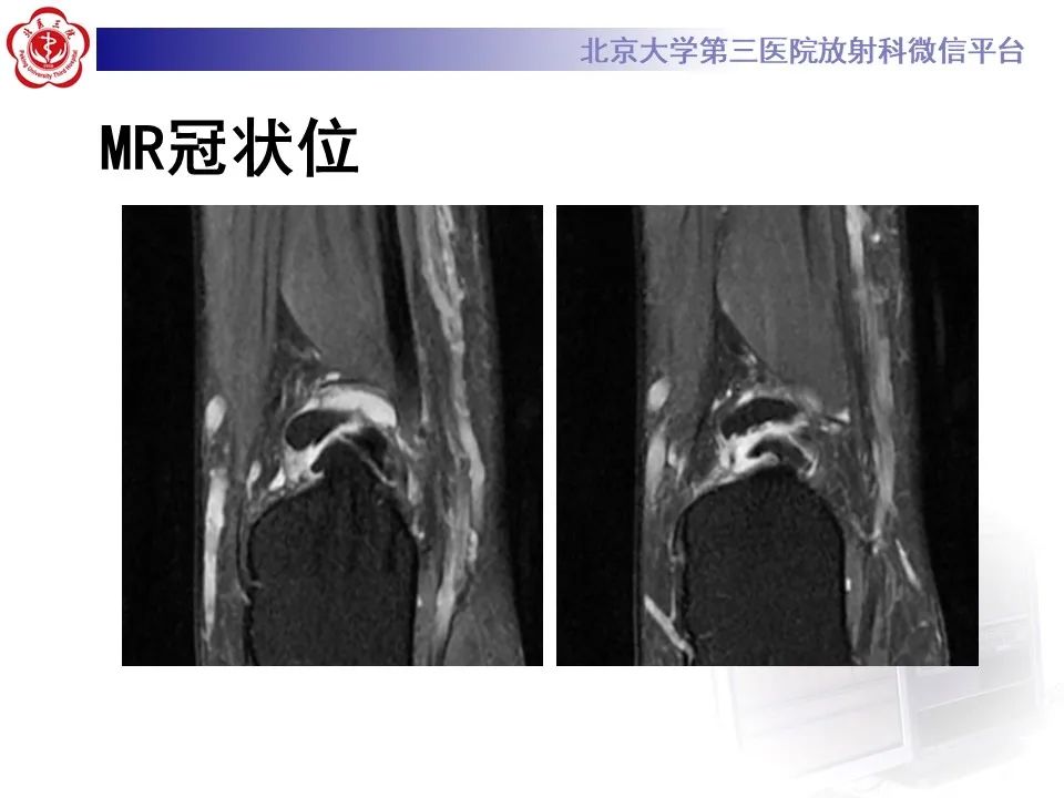 影像PPT - 【病例】踝关节后方撞击综合征1例X线CT及MR影像-7