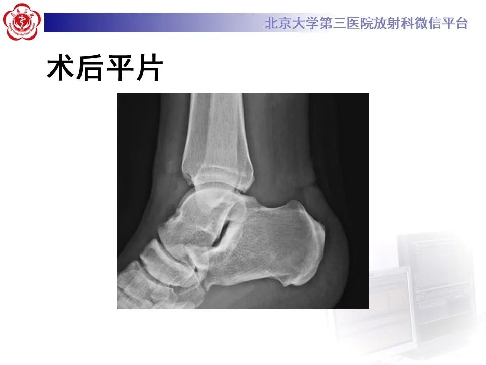 影像PPT - 【病例】踝关节后方撞击综合征1例X线CT及MR影像-11