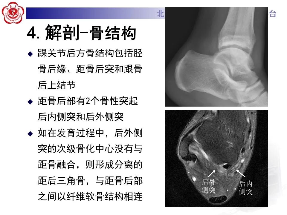 影像PPT - 【病例】踝关节后方撞击综合征1例X线CT及MR影像-18