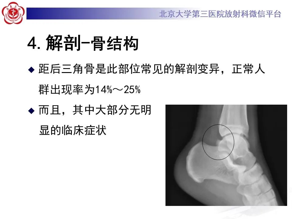 影像PPT - 【病例】踝关节后方撞击综合征1例X线CT及MR影像-19