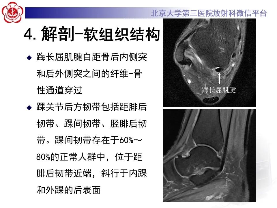 影像PPT - 【病例】踝关节后方撞击综合征1例X线CT及MR影像-20