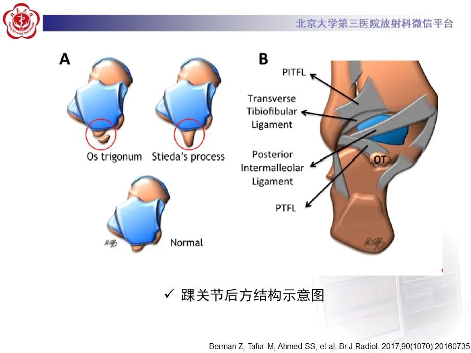 影像PPT - 【病例】踝关节后方撞击综合征1例X线CT及MR影像-21