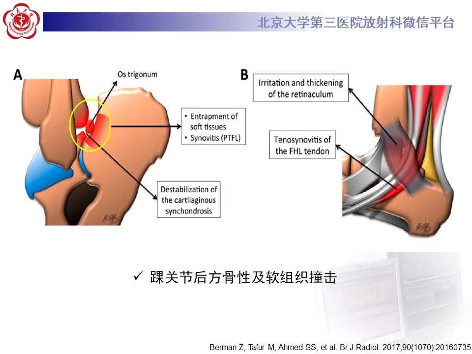 影像PPT - 【病例】踝关节后方撞击综合征1例X线CT及MR影像-24
