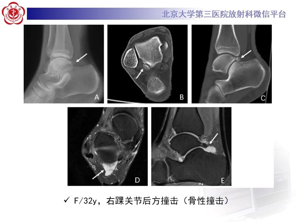 影像PPT - 【病例】踝关节后方撞击综合征1例X线CT及MR影像-29