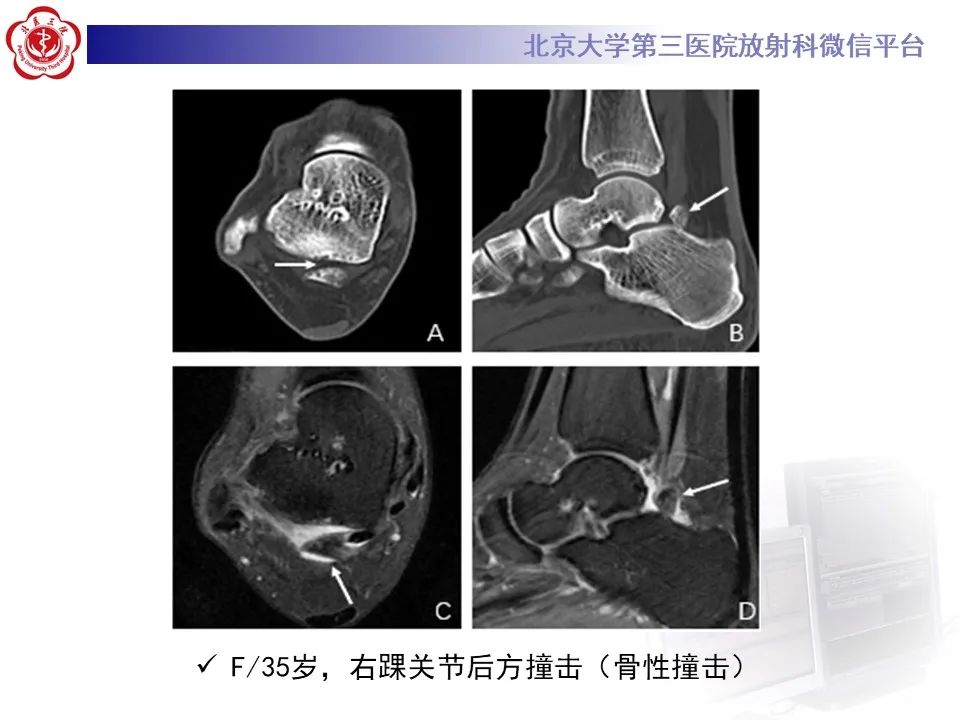 影像PPT - 【病例】踝关节后方撞击综合征1例X线CT及MR影像-30