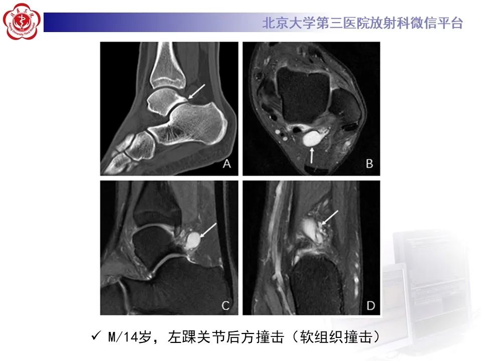 影像PPT - 【病例】踝关节后方撞击综合征1例X线CT及MR影像-31