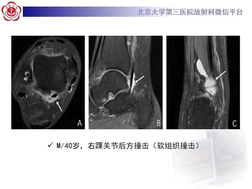 影像PPT - 【病例】踝关节后方撞击综合征1例X线CT及MR影像-32