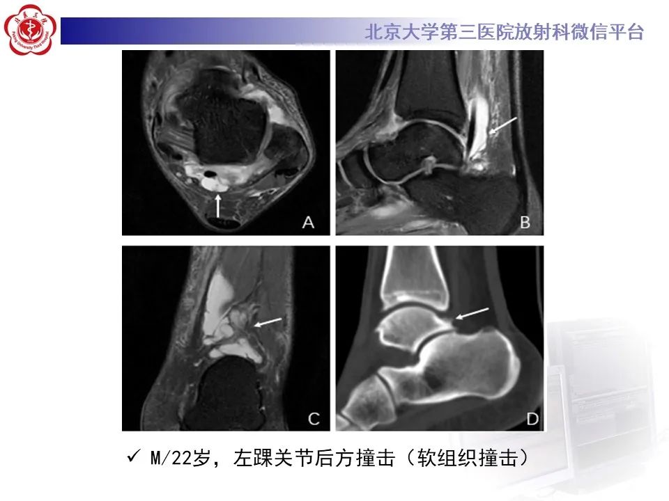 影像PPT - 【病例】踝关节后方撞击综合征1例X线CT及MR影像-33
