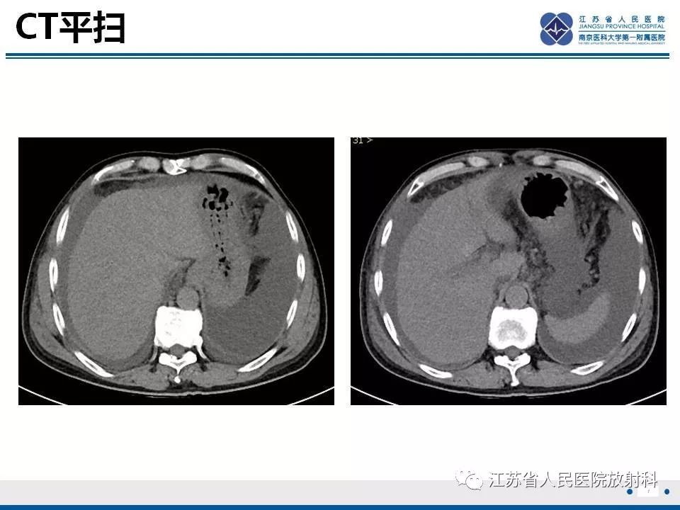 影像PPT - 【病例】肝小静脉闭塞病HVOD一例CT影像-8