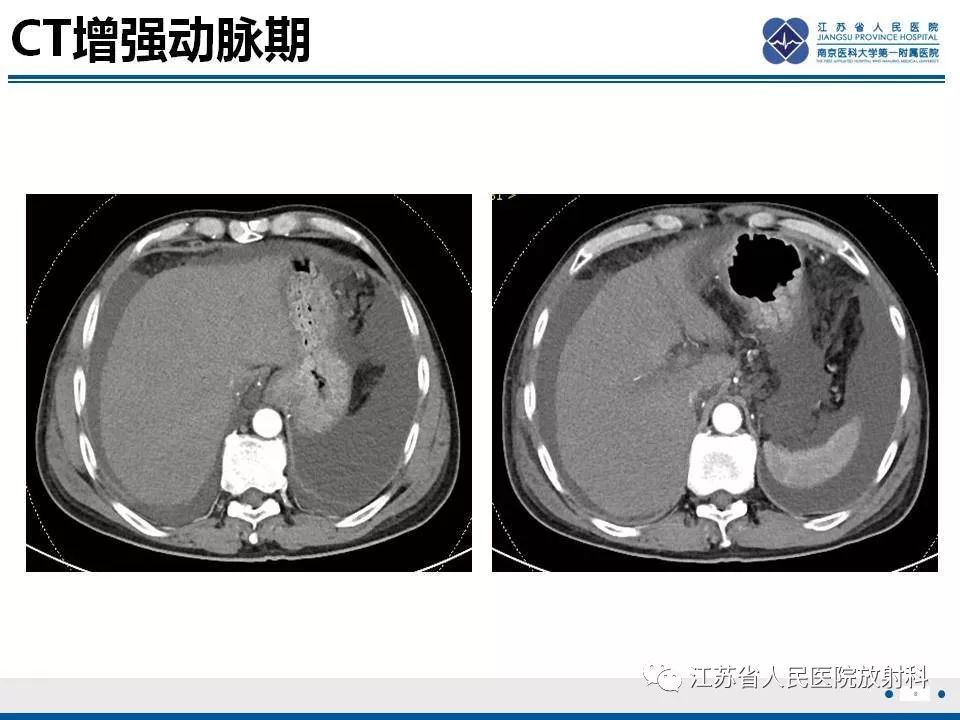 影像PPT - 【病例】肝小静脉闭塞病HVOD一例CT影像-9