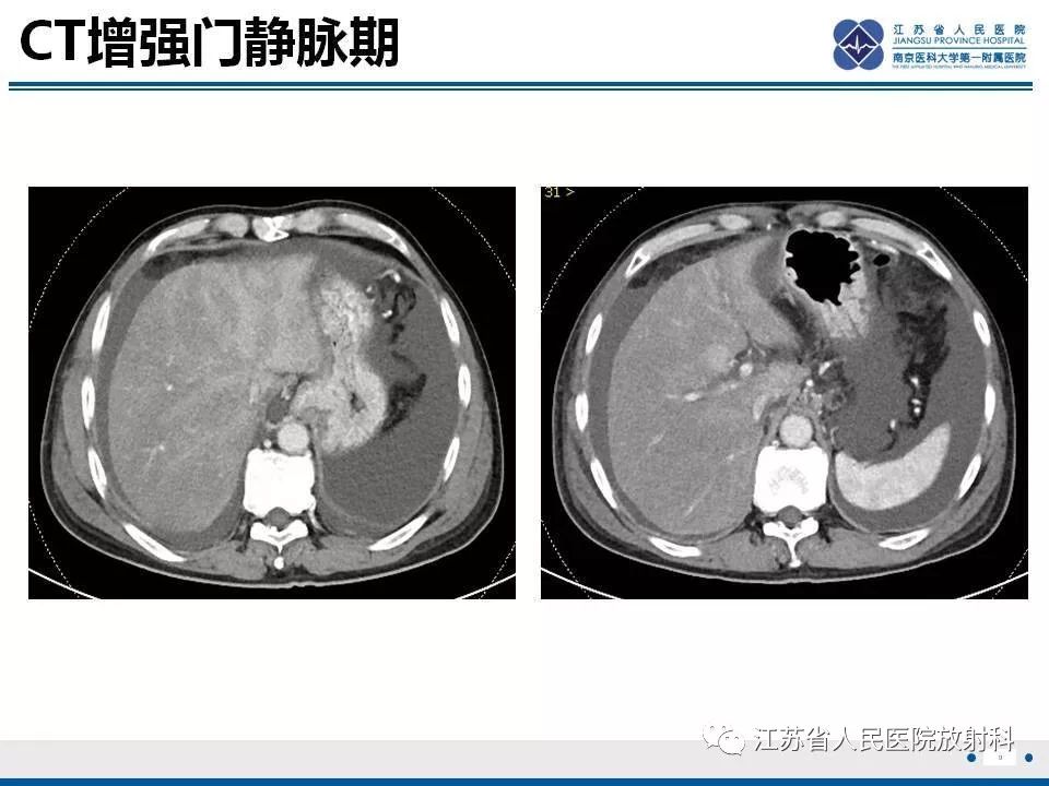 影像PPT - 【病例】肝小静脉闭塞病HVOD一例CT影像-10