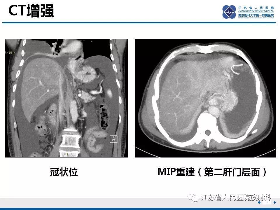 影像PPT - 【病例】肝小静脉闭塞病HVOD一例CT影像-11