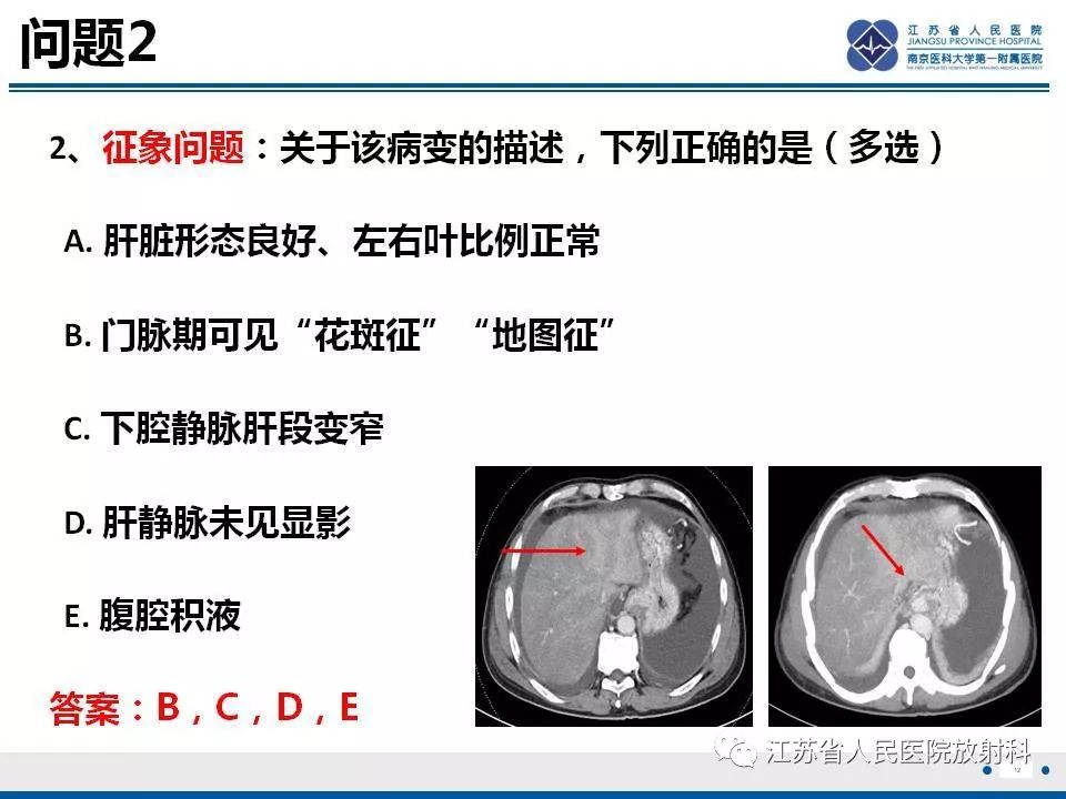 影像PPT - 【病例】肝小静脉闭塞病HVOD一例CT影像-13