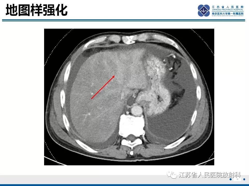 影像PPT - 【病例】肝小静脉闭塞病HVOD一例CT影像-22