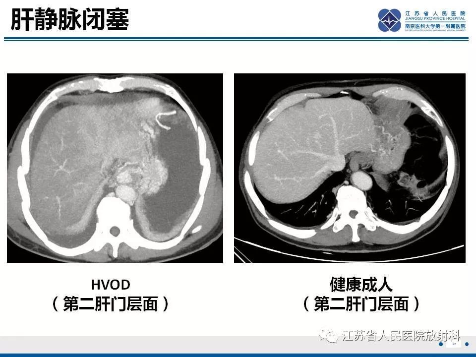 影像PPT - 【病例】肝小静脉闭塞病HVOD一例CT影像-23