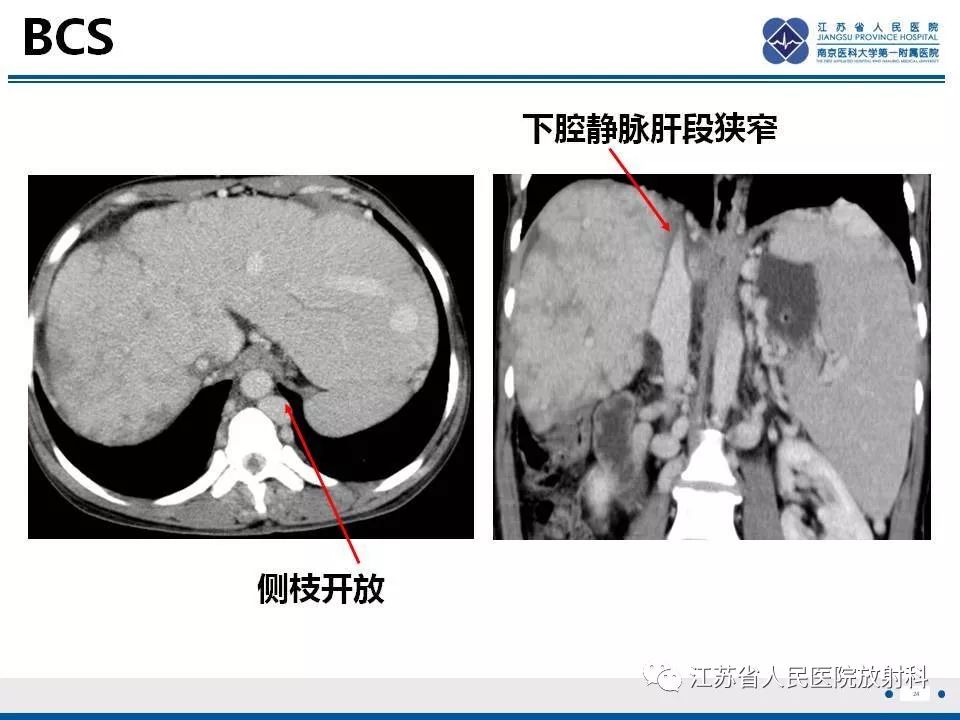 影像PPT - 【病例】肝小静脉闭塞病HVOD一例CT影像-25