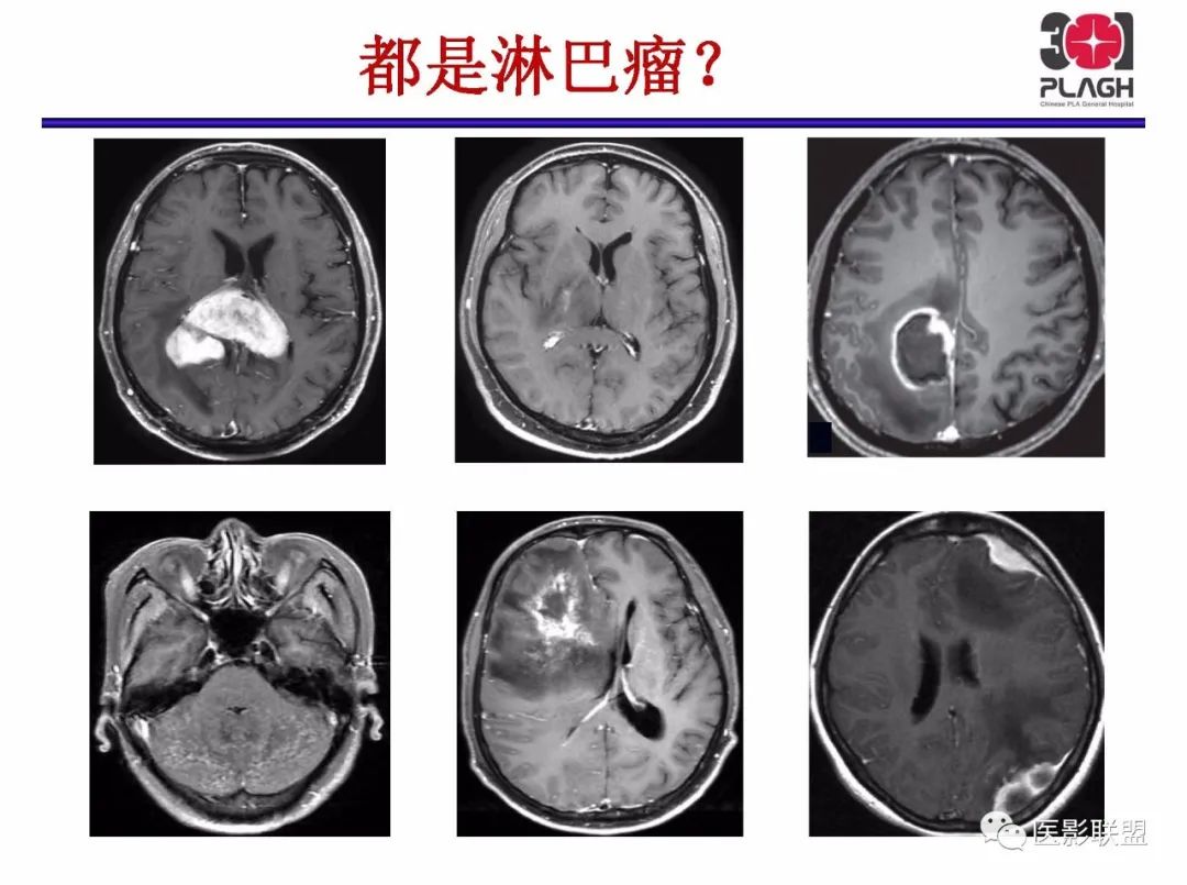 影像PPT - 【PPT】不典型原发中枢神经系统淋巴瘤影像诊断思路-6
