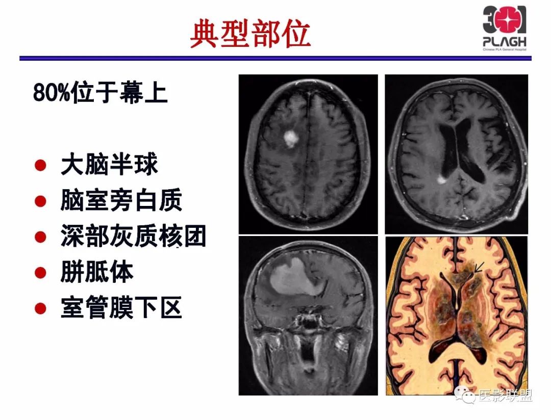 影像PPT - 【PPT】不典型原发中枢神经系统淋巴瘤影像诊断思路-11