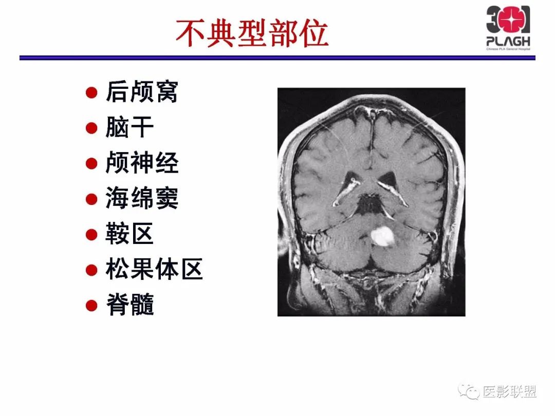 影像PPT - 【PPT】不典型原发中枢神经系统淋巴瘤影像诊断思路-12