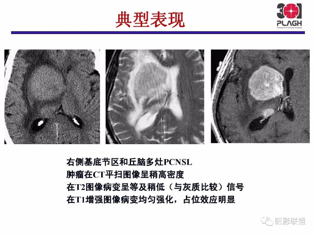 影像PPT - 【PPT】不典型原发中枢神经系统淋巴瘤影像诊断思路-14