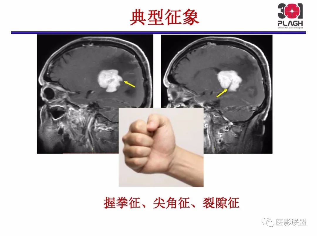 影像PPT - 【PPT】不典型原发中枢神经系统淋巴瘤影像诊断思路-15