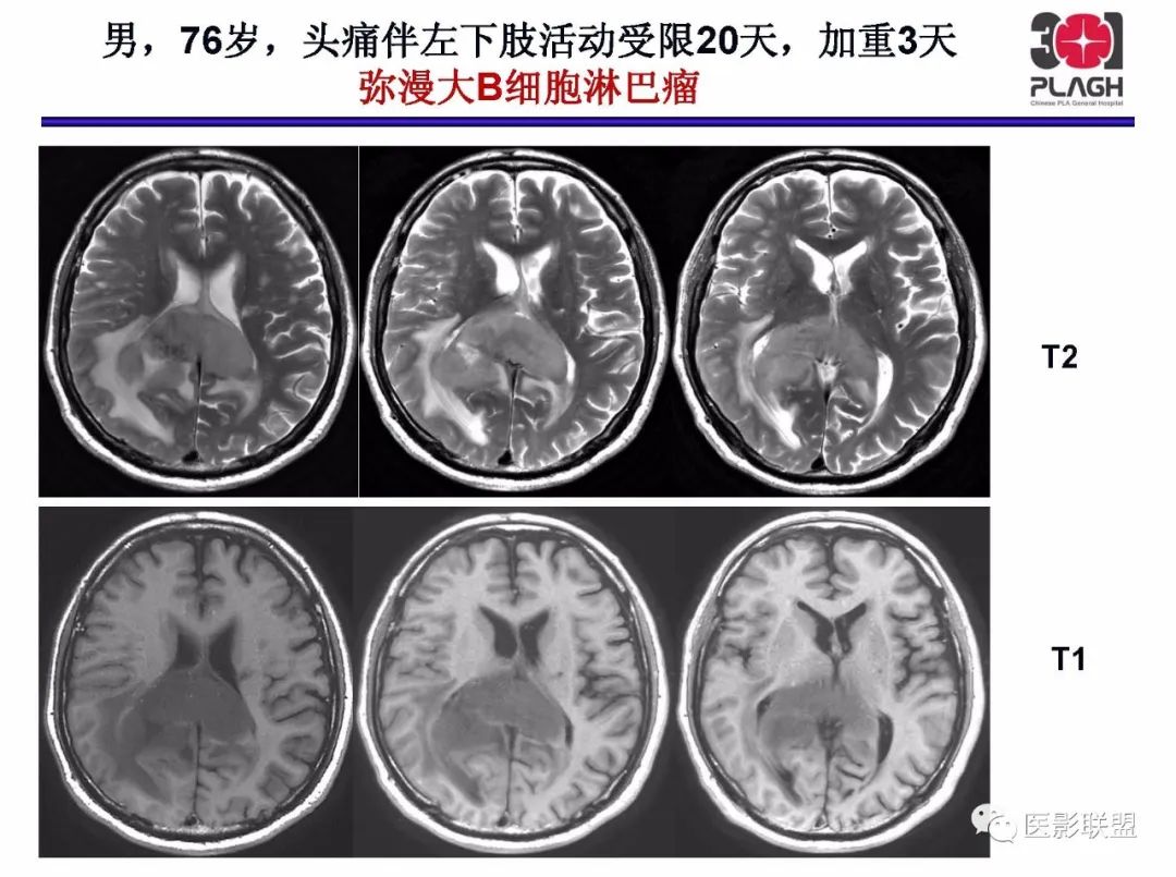 影像PPT - 【PPT】不典型原发中枢神经系统淋巴瘤影像诊断思路-16