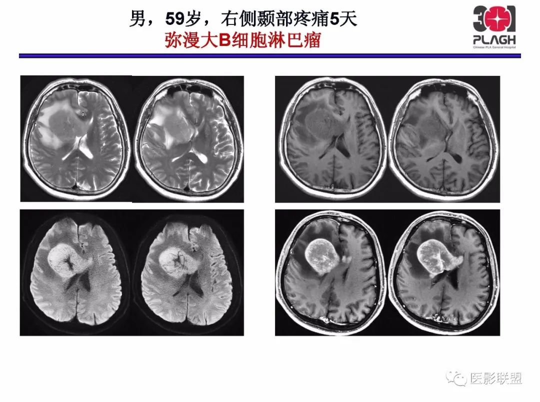 影像PPT - 【PPT】不典型原发中枢神经系统淋巴瘤影像诊断思路-20
