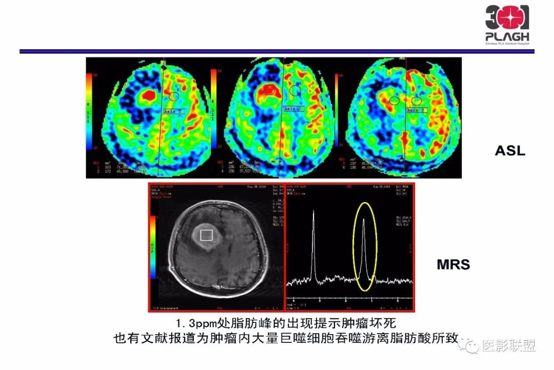 影像PPT - 【PPT】不典型原发中枢神经系统淋巴瘤影像诊断思路-21