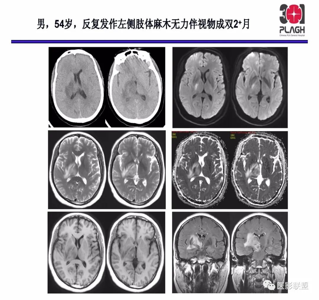 影像PPT - 【PPT】不典型原发中枢神经系统淋巴瘤影像诊断思路-22