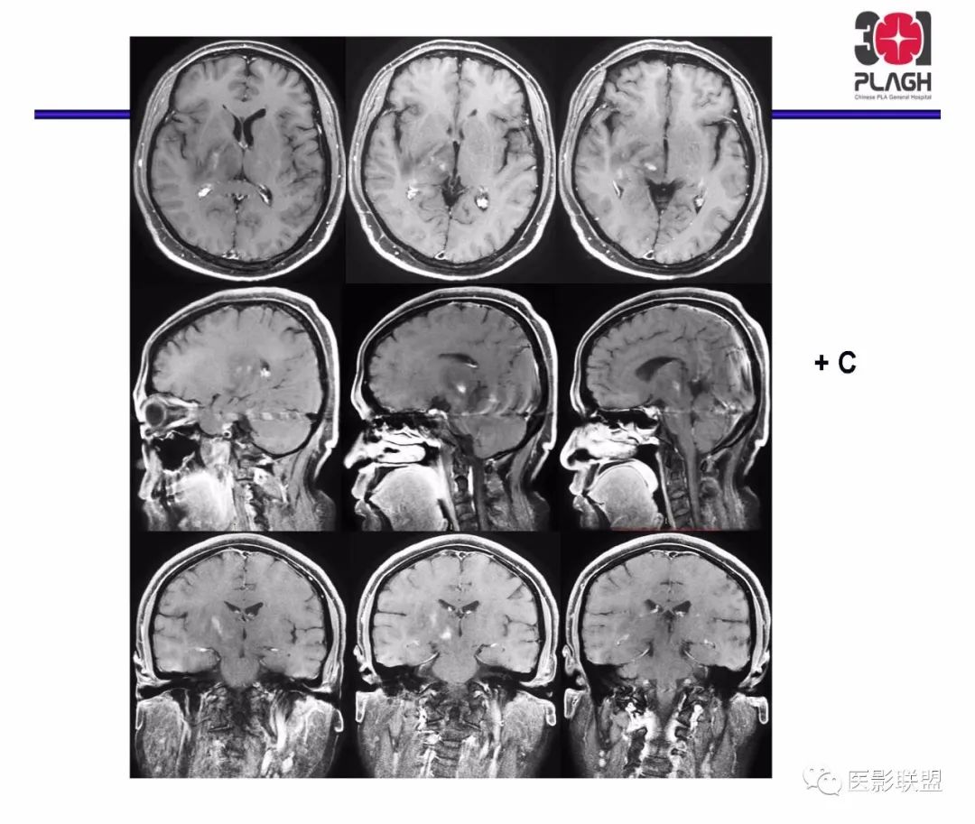 影像PPT - 【PPT】不典型原发中枢神经系统淋巴瘤影像诊断思路-24