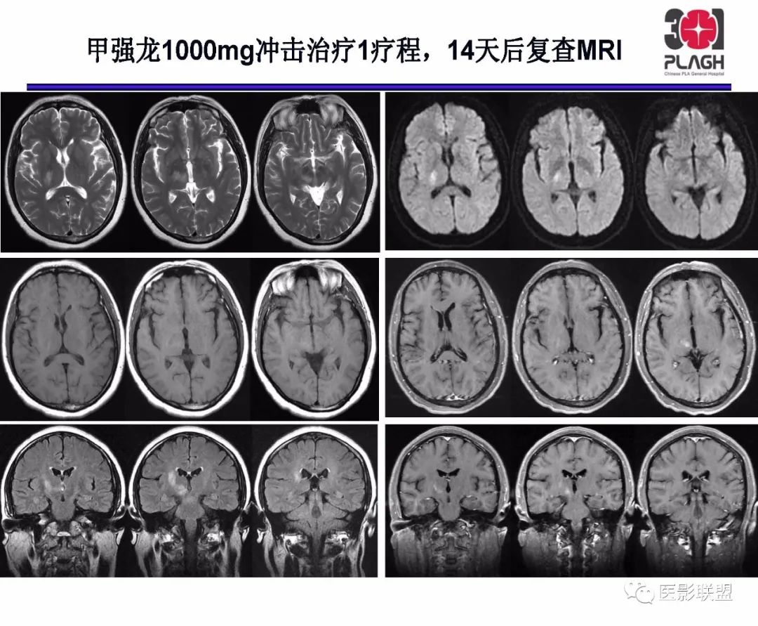 影像PPT - 【PPT】不典型原发中枢神经系统淋巴瘤影像诊断思路-25